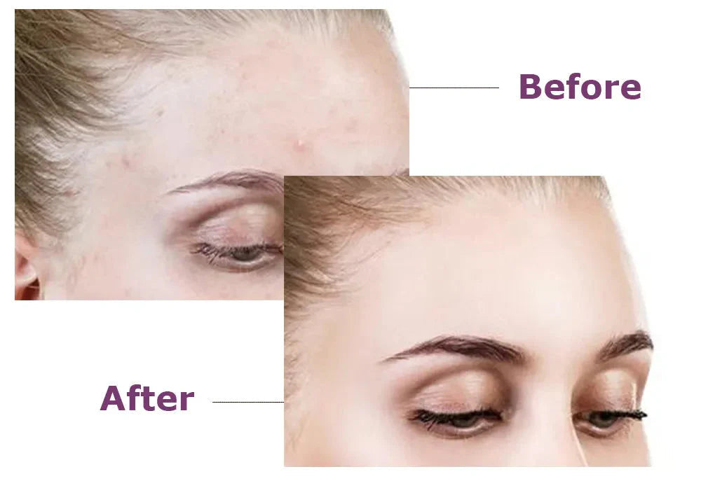 Acne Pac™ Odstraňovač pupínků