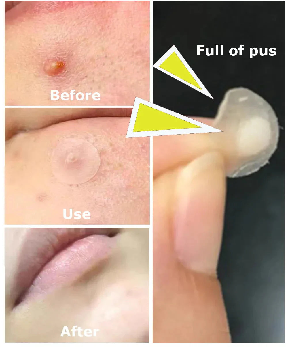 Acne Pac™ Odstraňovač pupínků