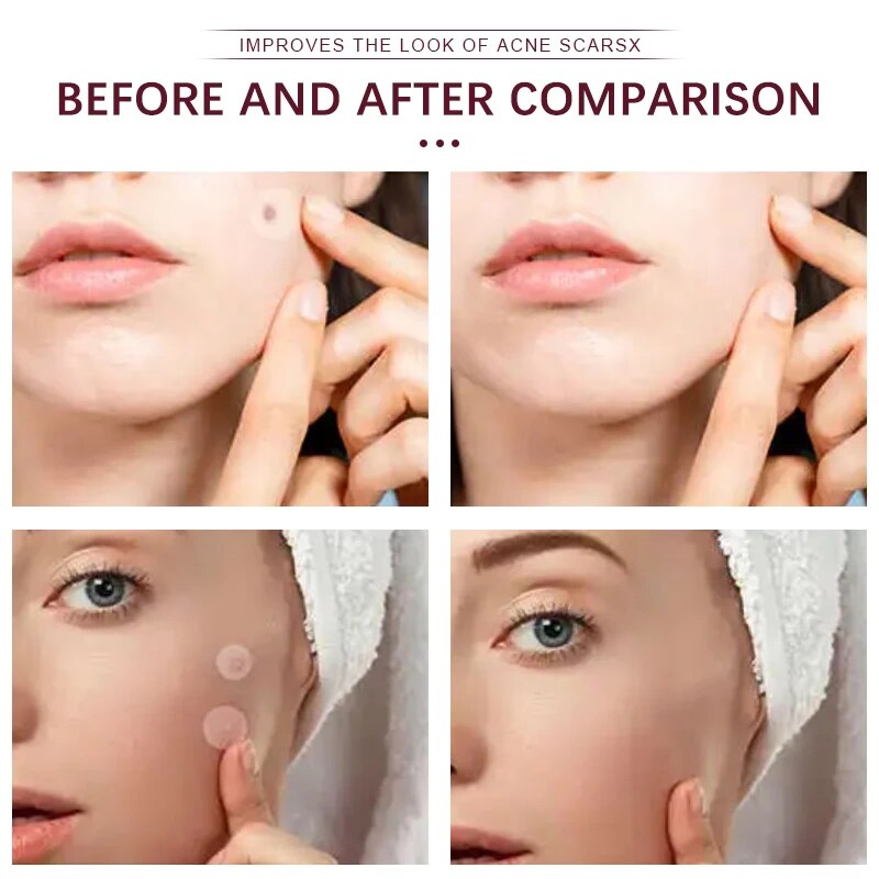 Acne Pac™ Odstraňovač pupínků