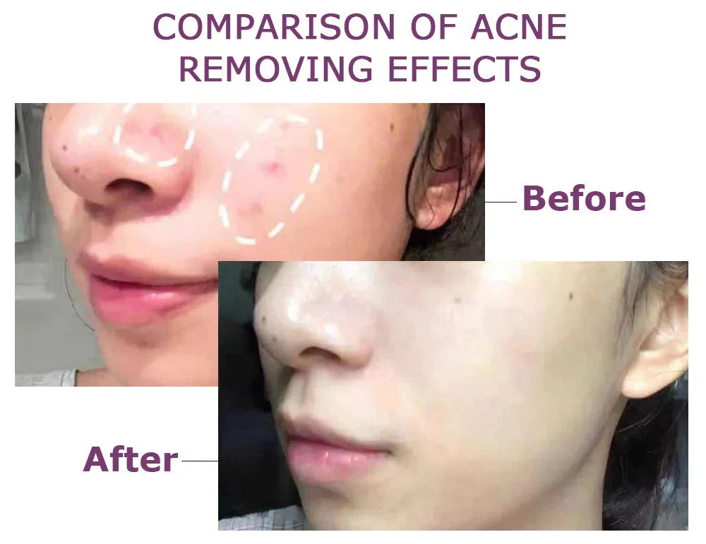 Acne Pac™ Odstraňovač pupínků