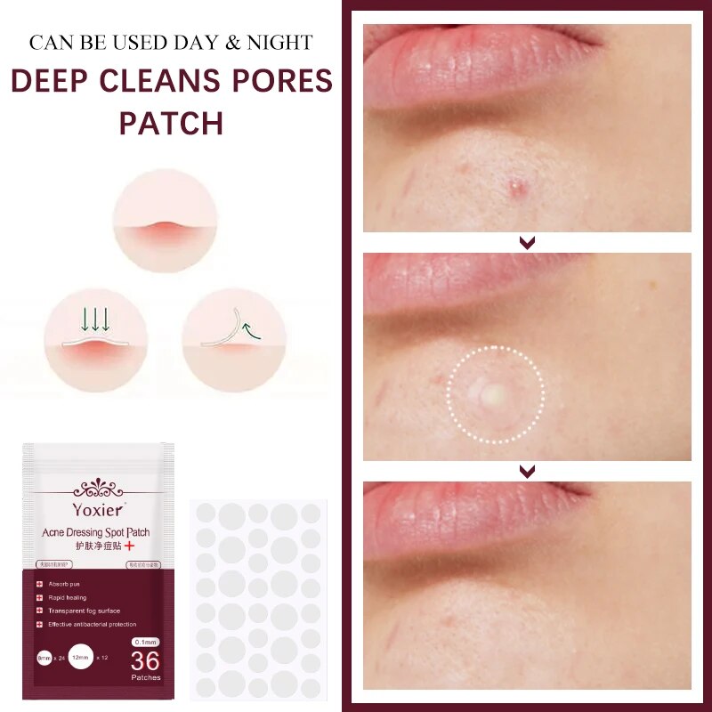 Acne Pac™ Odstraňovač pupínků