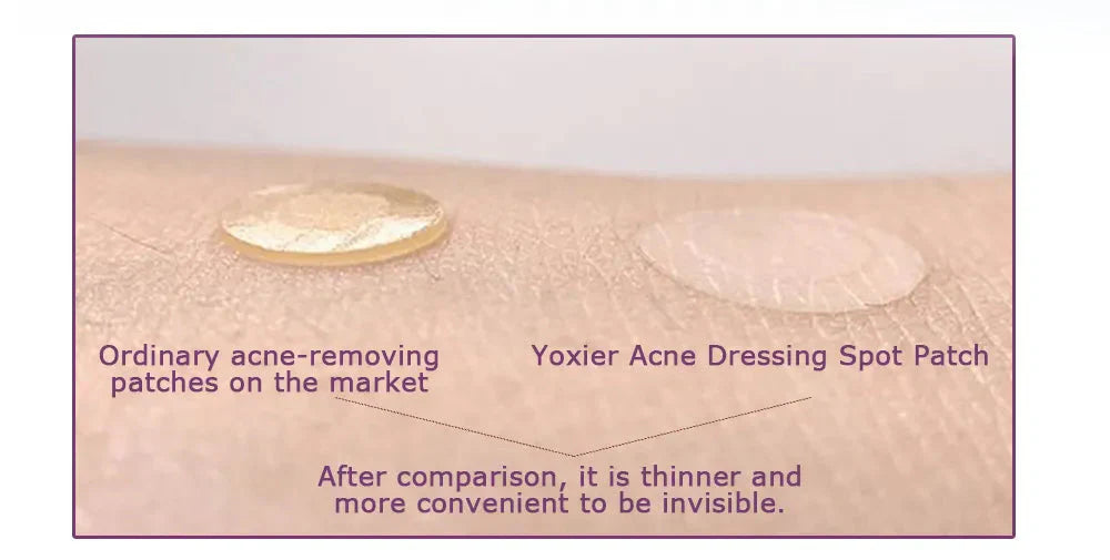 Acne Pac™ Odstraňovač pupínků