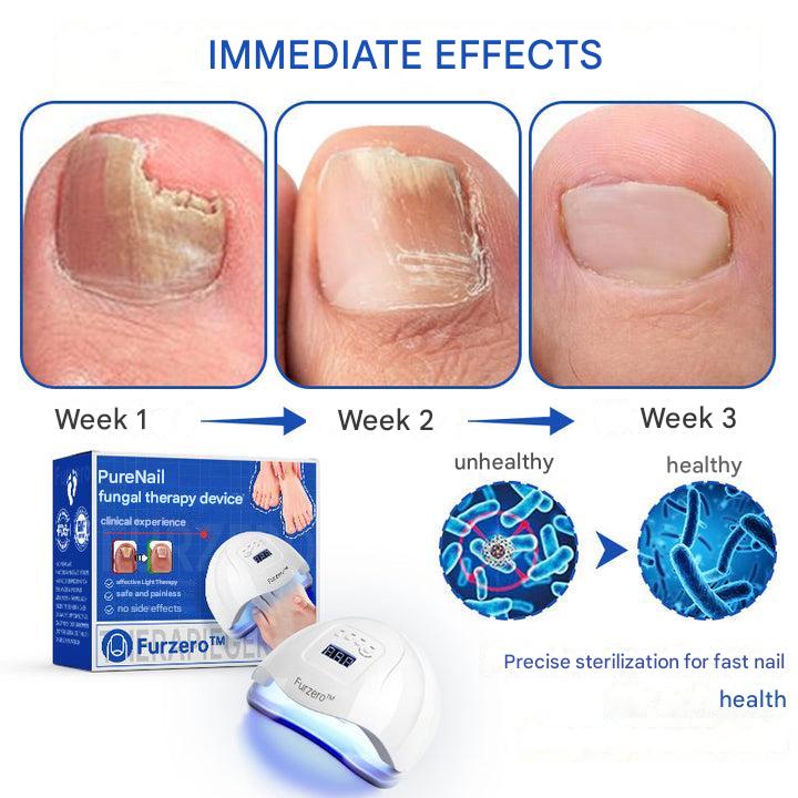 ClearZap+™ Zařízení pro světelnou terapii plísní | Rychlé, účinné a bezbolestné řešení!