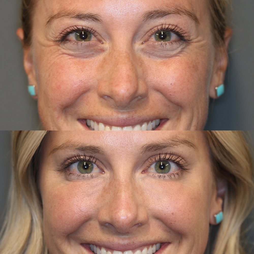 EELHOE EyeCream™ Retinolový oční krém v tyčince