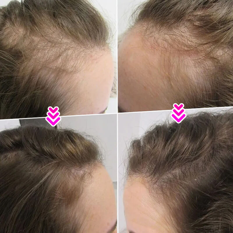 EELHOE HAIR™ Prášek proti vypadávání a rychlé vyplnění vlasové linie