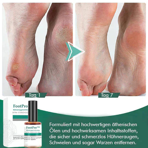 FootPro™️ Gel na odstraňování kukuřice