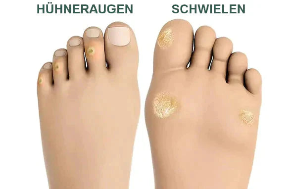 FootPro™️ Gel na odstraňování kukuřice