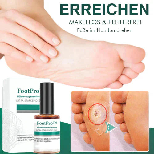FootPro™️ Gel na odstraňování kukuřice