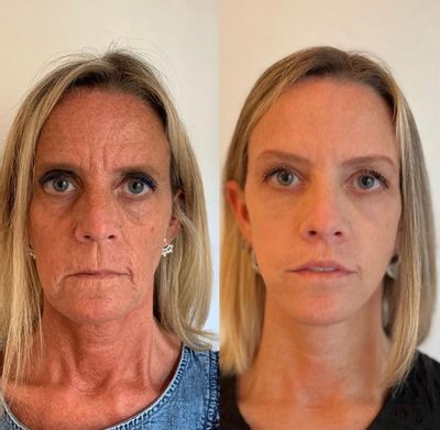 Before after picture of woman that used the collagen mask