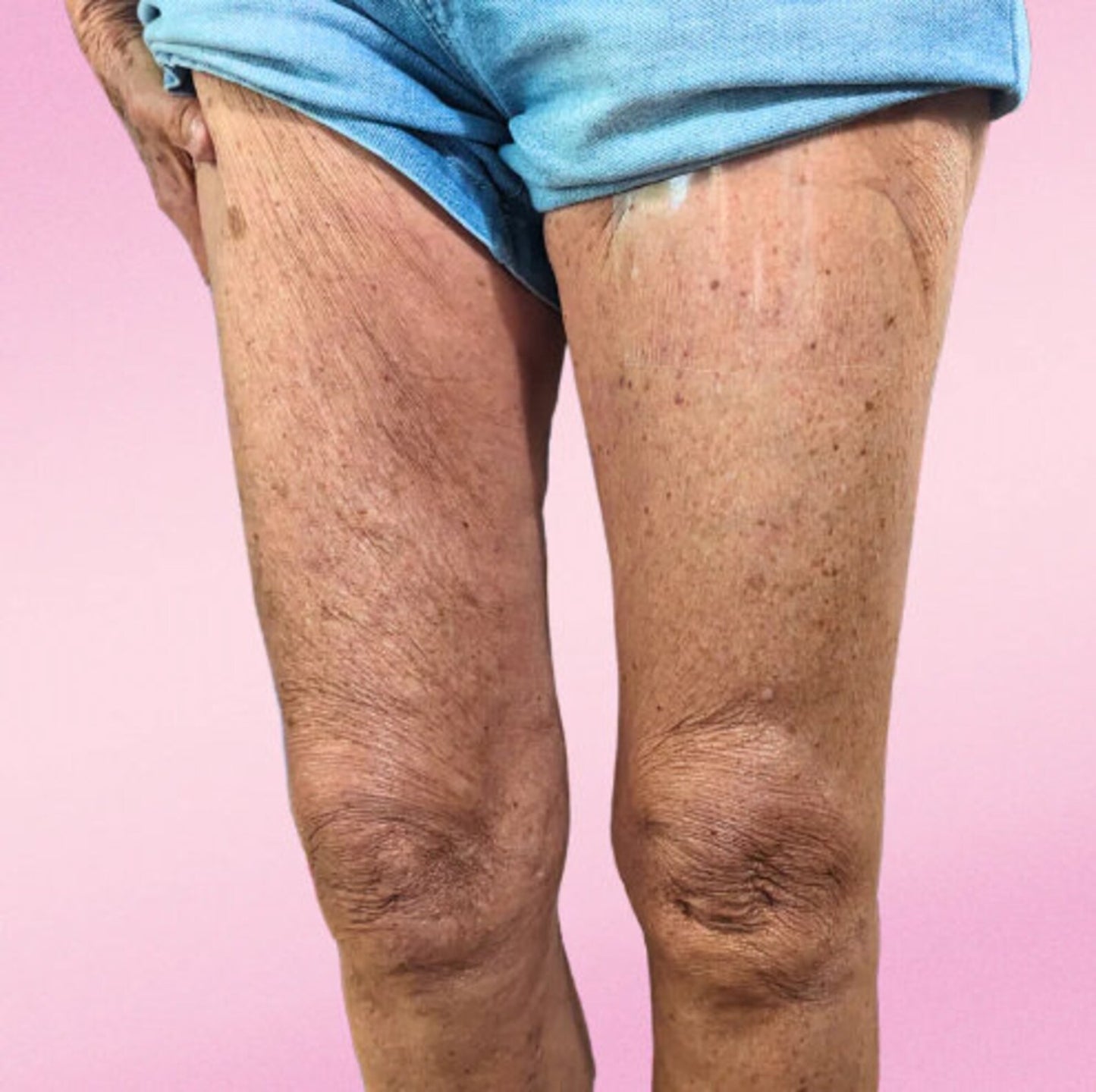 Invisilift™ Neviditelné zpevňující náplasti