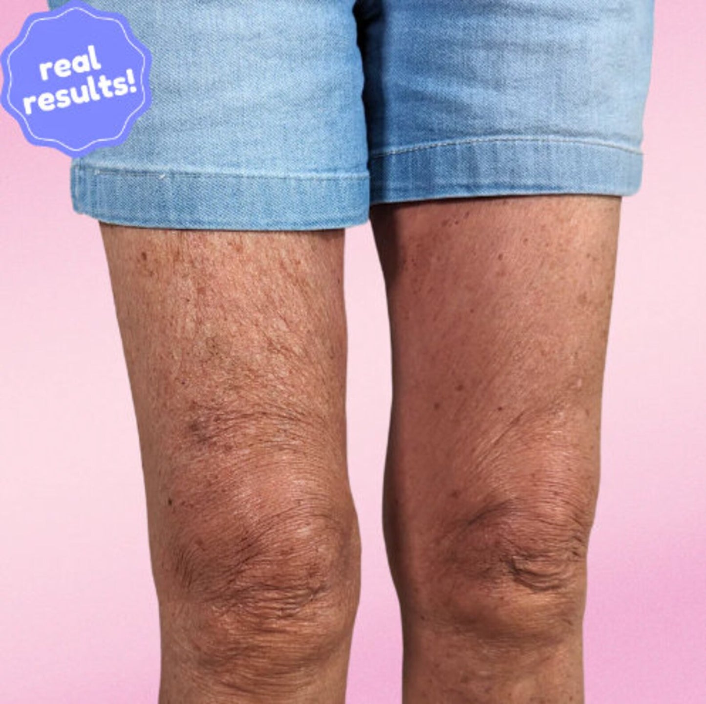 Invisilift™ Neviditelné zpevňující náplasti