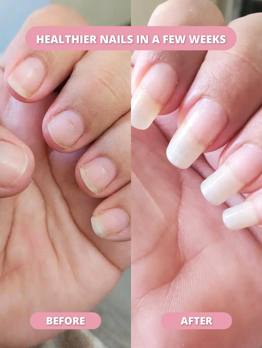 NailForté™ Posilovač nehtů
