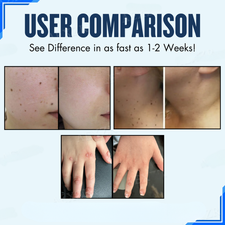 SkinFix™ Náplasti na odstraňování kožních skvrn a znamének