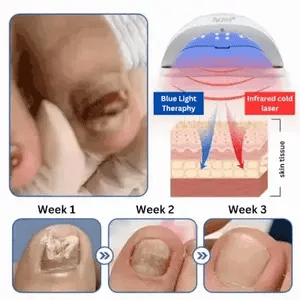 ClearZap+™ Zařízení pro laserovou terapii plísní | Rychlé, účinné a bezbolestné řešení!