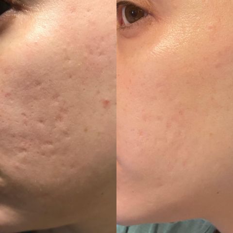 RejuvePatch™ Opakovně použitelné náplasti proti nedokonalostem na obličeji