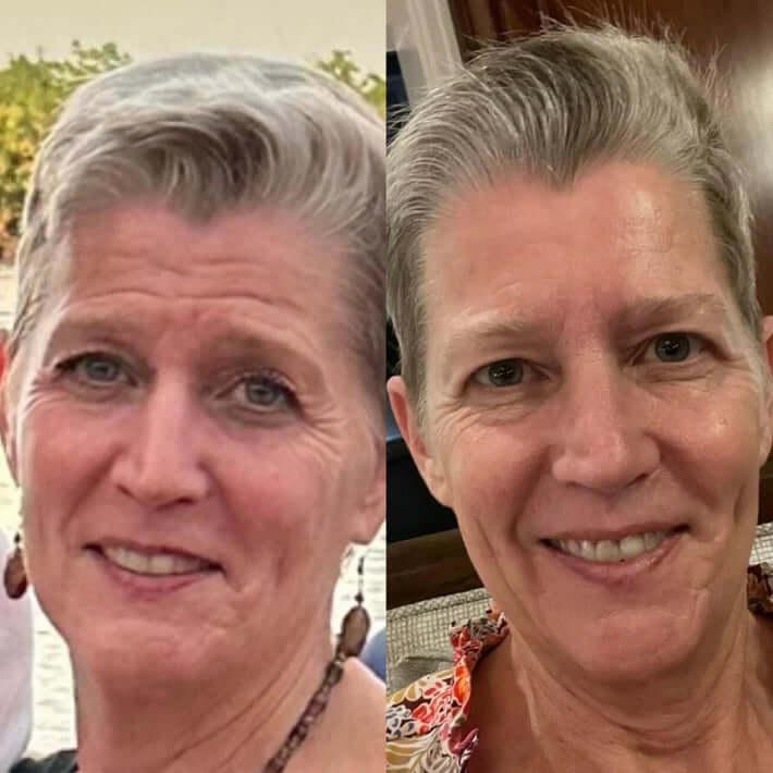 RejuvePatch™ Opakovně použitelné náplasti proti nedokonalostem na obličeji